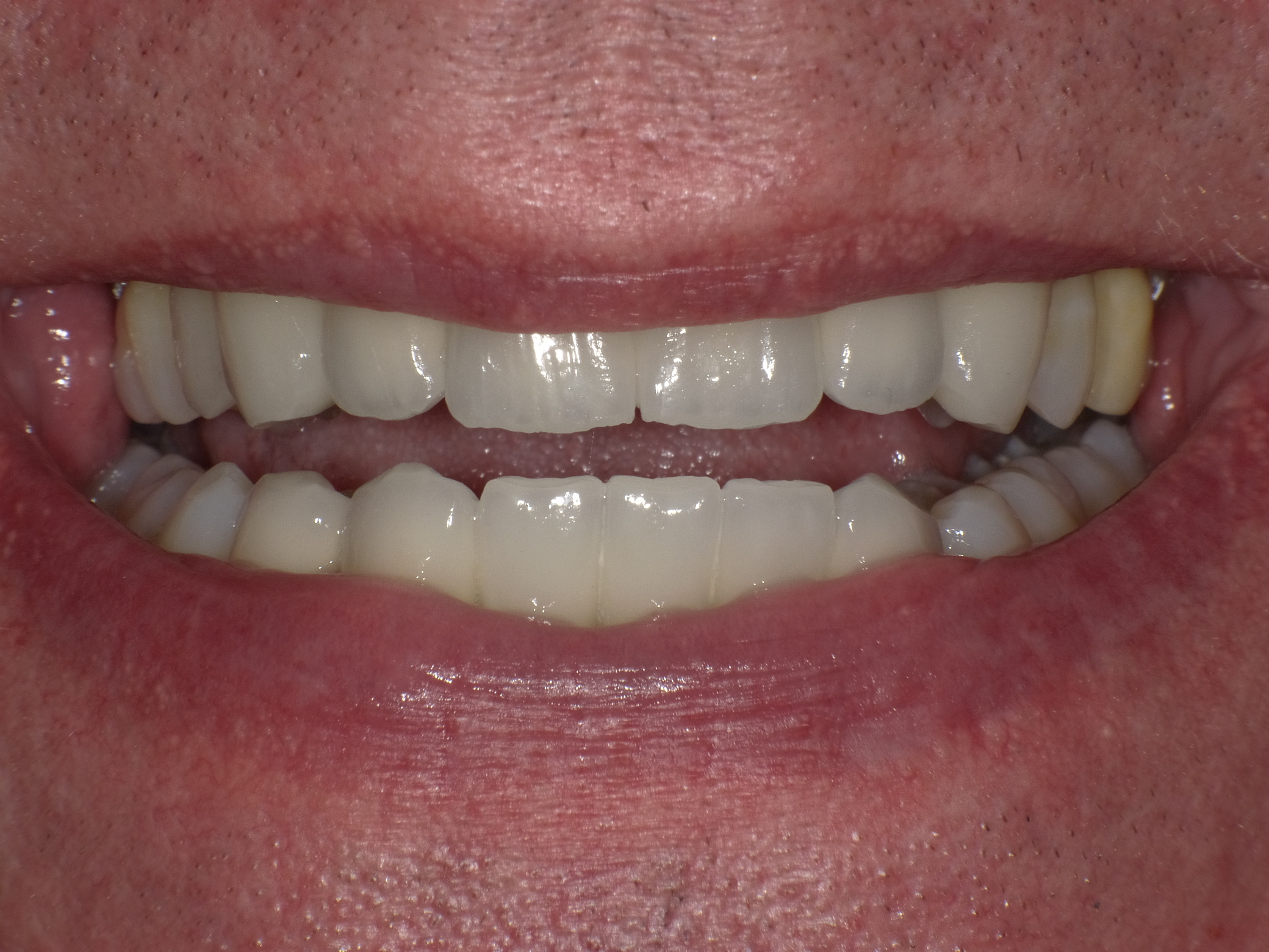 Systematische Korrektur mit Parodontitis-Behandliung, Implantaten, Vollkeramischen Veneers und Kronen